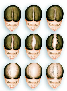 Hair Loss Treatment for Women | Female Hair Loss