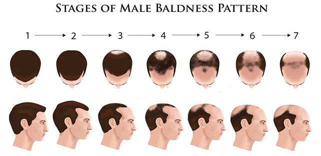 stages of male pattern baldness