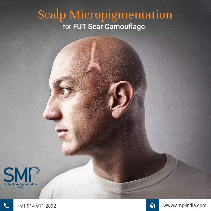 scalp micropigmentation for FUT scar